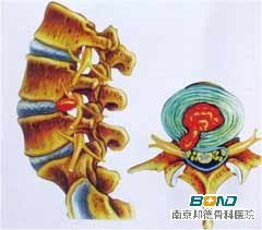 颈椎病有哪些类型