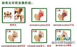 股骨头坏死是怎么回事