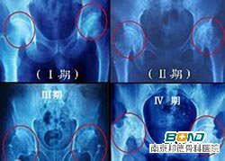 股骨头坏死年龄