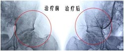 股骨头坏死针灸治疗吗