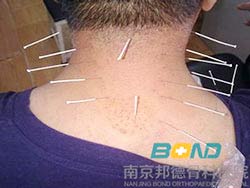 针灸治疗颈椎病效果怎么样