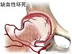 股骨头坏死有哪些症状