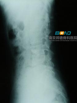 腰椎结核该怎么治疗？