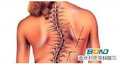 脊柱侧弯危害