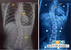 脊柱侧弯影响生育吗