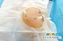 腰椎间盘突出压迫神经怎么办