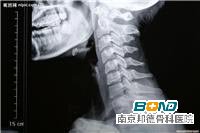 颈椎炎如何治疗？