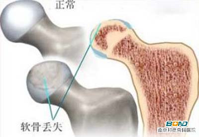 保守治疗股骨头坏死的方法