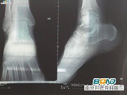 创伤性关节炎的检查方式