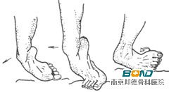 关节运动损伤该如何处理