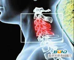 骨质增生压迫神经
