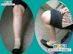 如何治疗骨质增生效果好