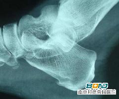 骨刺的常见症状