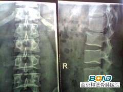 腰椎骨刺是怎么引起的