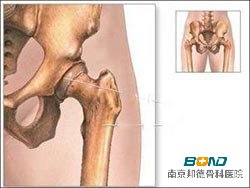 坐骨神经痛是什么引起的？ 
