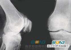 骨刺的治疗方法是什么