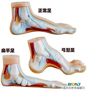 正常足与扁平足的区别