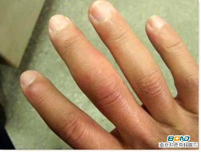 手指关节肿大疼痛