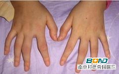 类风湿性关节炎的症状