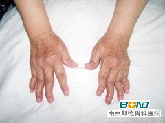 类风湿性关节炎的治疗费用