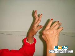 类风湿性关节炎的治疗