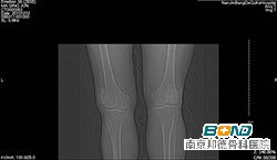检查结果：双膝骨性关节炎