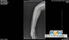 右桡骨远端骨折