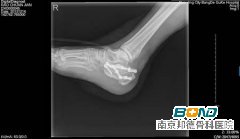 右侧跟骨骨折术后复查