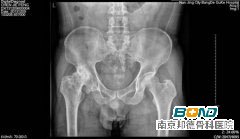 检查结果：侧有股骨头无菌性坏死