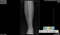 术前检查：左胫骨中下段粉碎性骨折