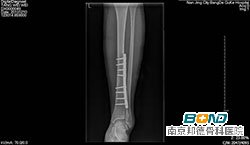 术后复查：术前检查，左胫骨中下段粉碎性骨折