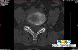 CT检查：腰4-5椎间盘突出