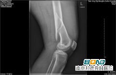 检查所见：左股骨下段粉碎性骨折