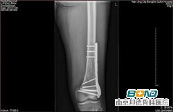 诊断结论： 左股骨下段粉碎性骨折内固定复位术后