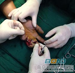 左中环指压砸性离断