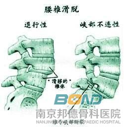 腰椎滑脱症状有哪些？
