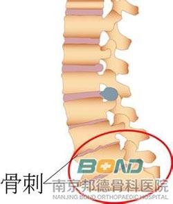 腰椎骨刺症状有哪些？