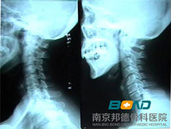 颈椎骨质增生