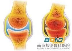 骨关节炎的症状