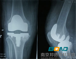 膝关节置换