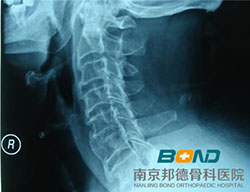 颈椎骨质增生发生的原因有哪些