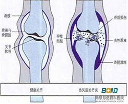 类风湿患者怕风怕冷是怎么回事