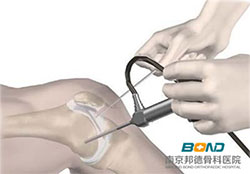 骨刺疼痛怎么治疗