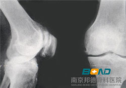 膝关节骨质增生治疗价格 