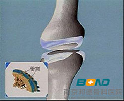 骨质增生严重吗 