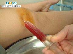 骨性关节炎怎么治疗
